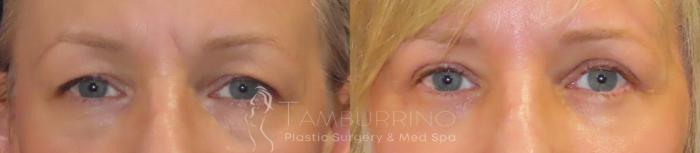 Before & After Eyelid Lift Case 50