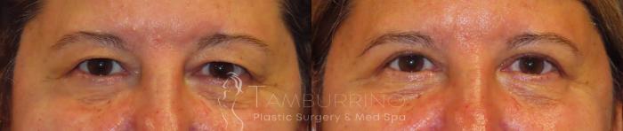 Before & After Eyelid Lift Case 51