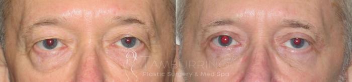 Before & After Eyelid Lift Case 54