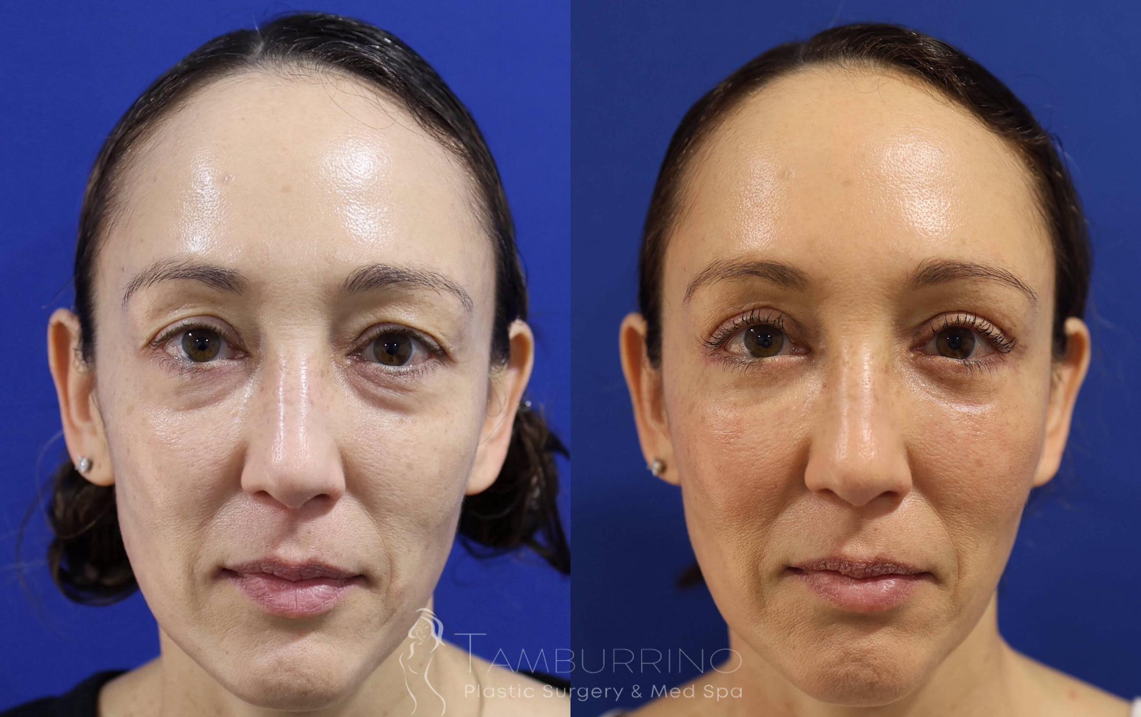 Before & After Eyelid Lift Case 72 Full Face View in Doylestown, PA