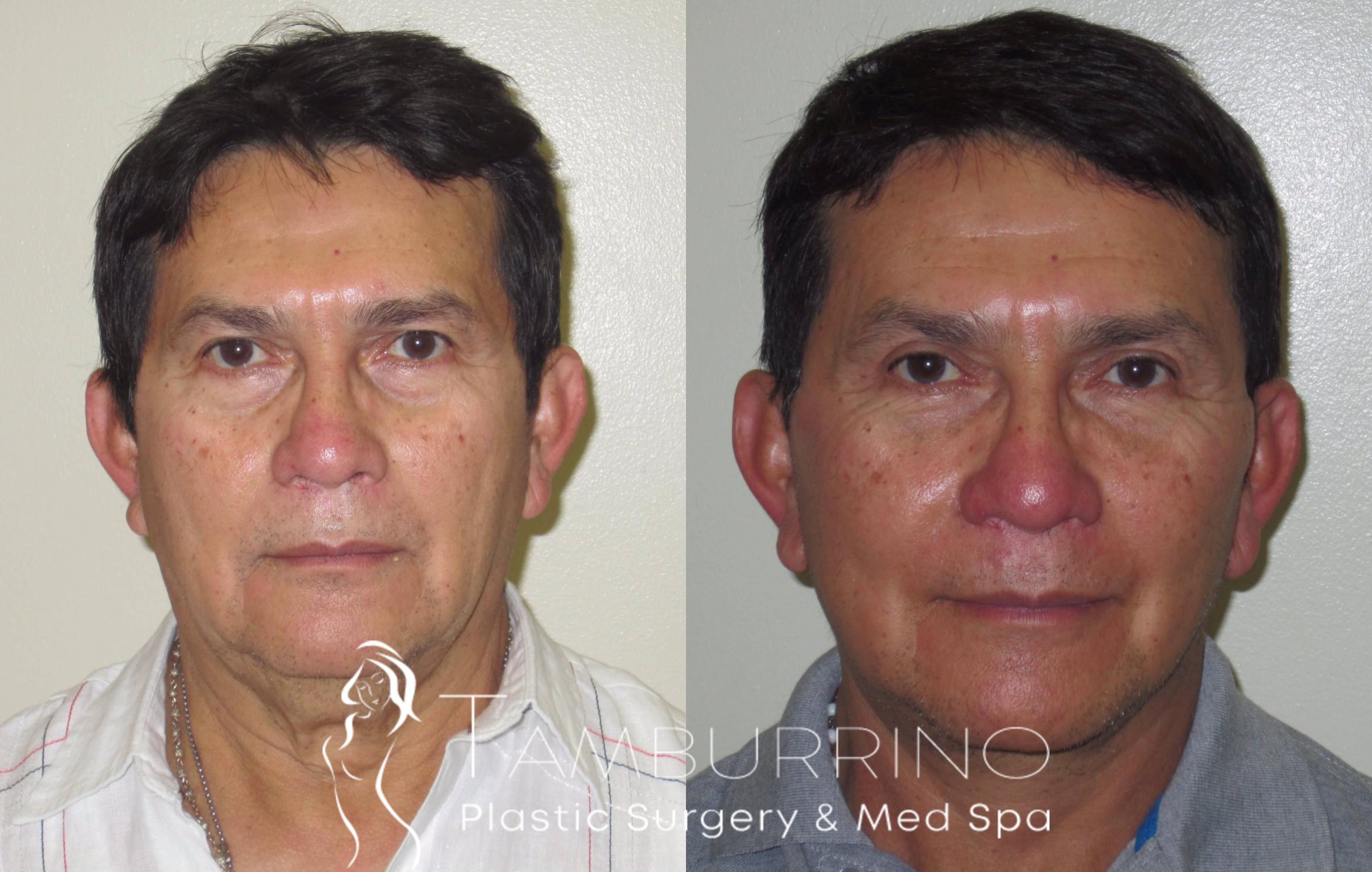 Before & After Facelift Case 20 Frontal View in Doylestown, PA