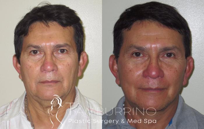 Facelift Before and After