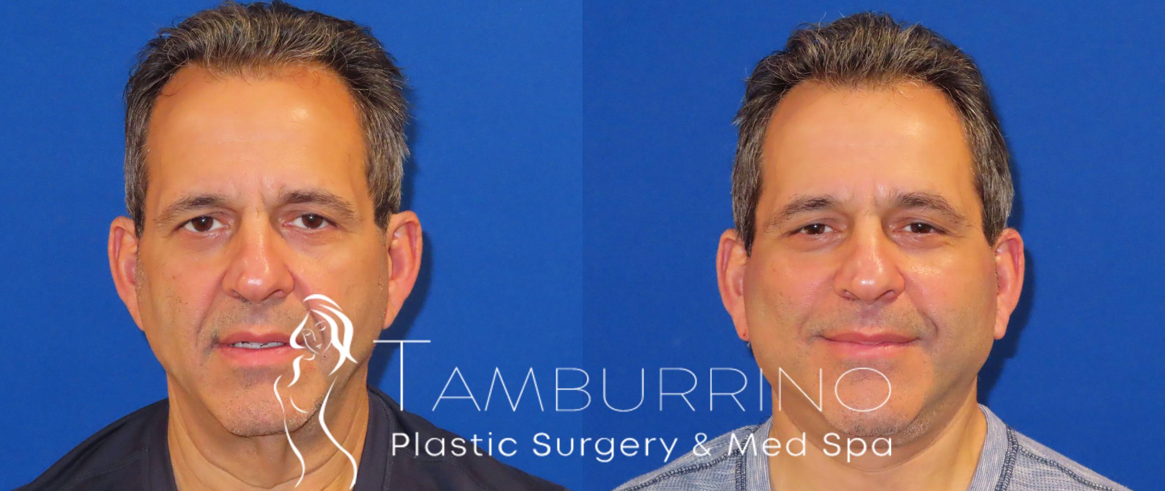 Before & After Facelift Case 24 Frontal View in Doylestown, PA
