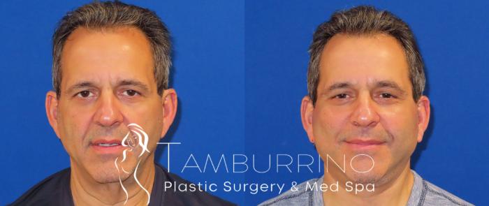 Before & After Neck Lift Case 24