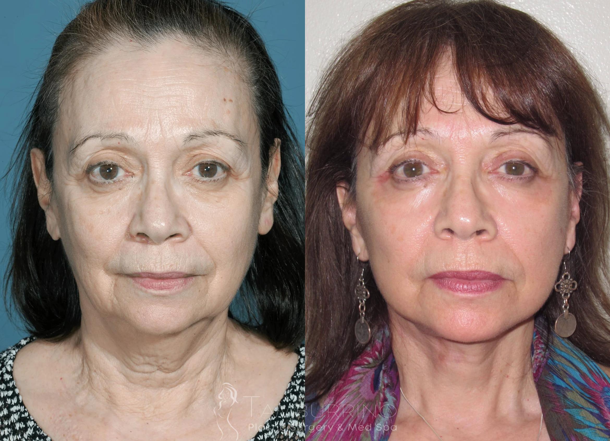 Before & After Facelift Case 25 Frontal View in Doylestown, PA