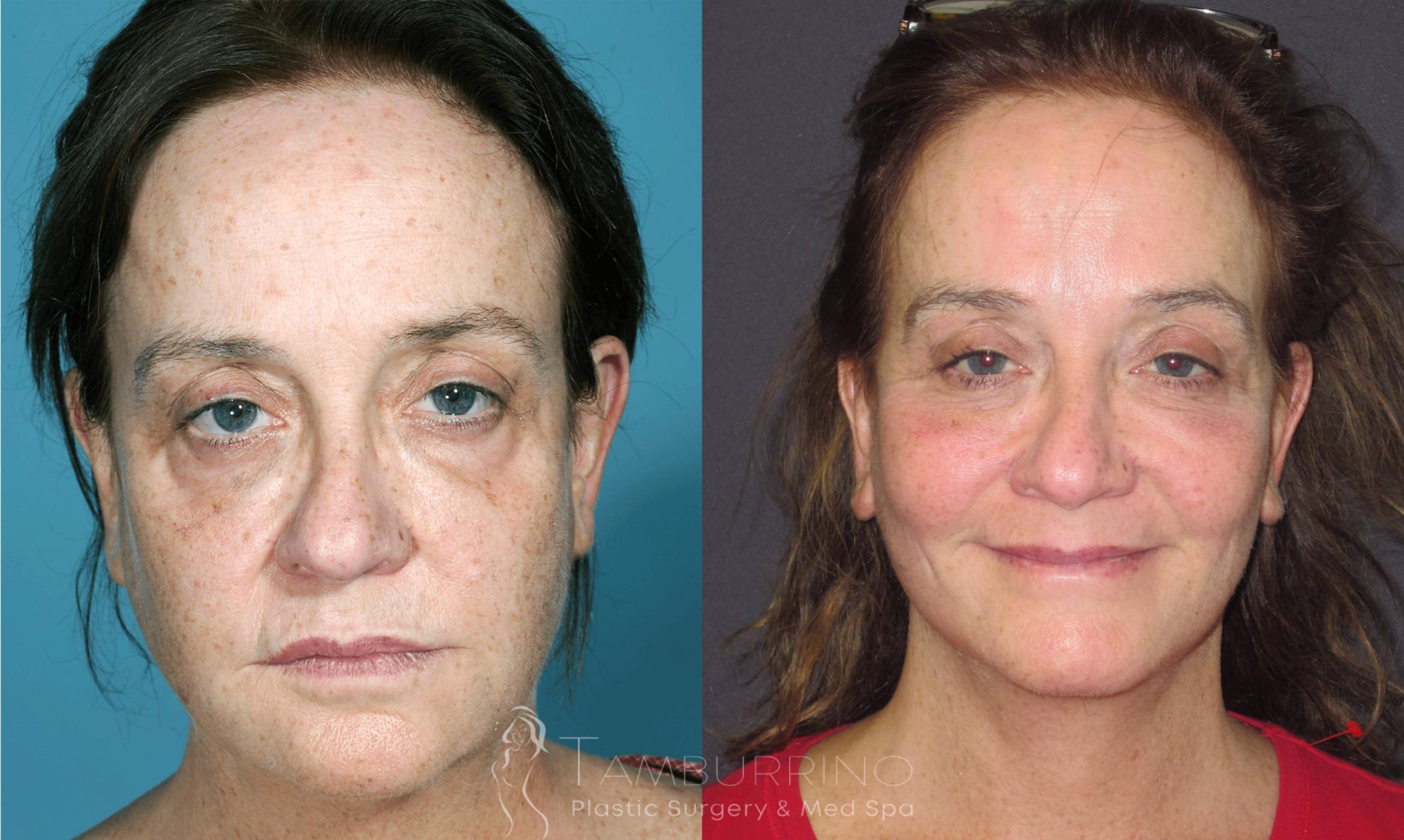 Before & After Facelift Case 26 Frontal View in Doylestown, PA