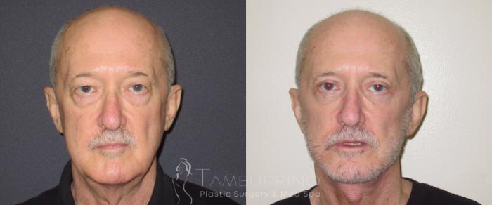 Before & After Neck Lift Case 53