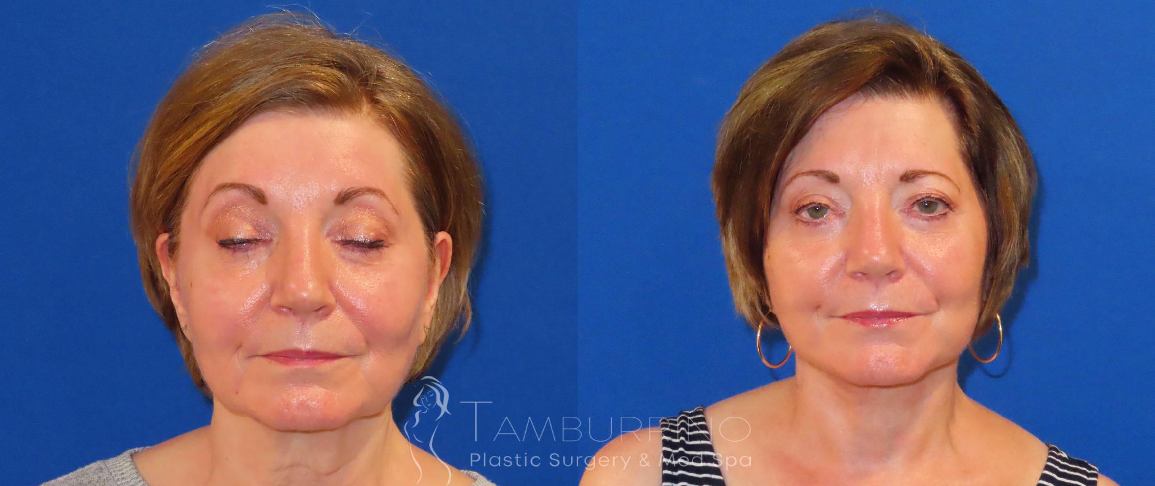 Before & After Facelift Case 57 Frontal View in Doylestown, PA