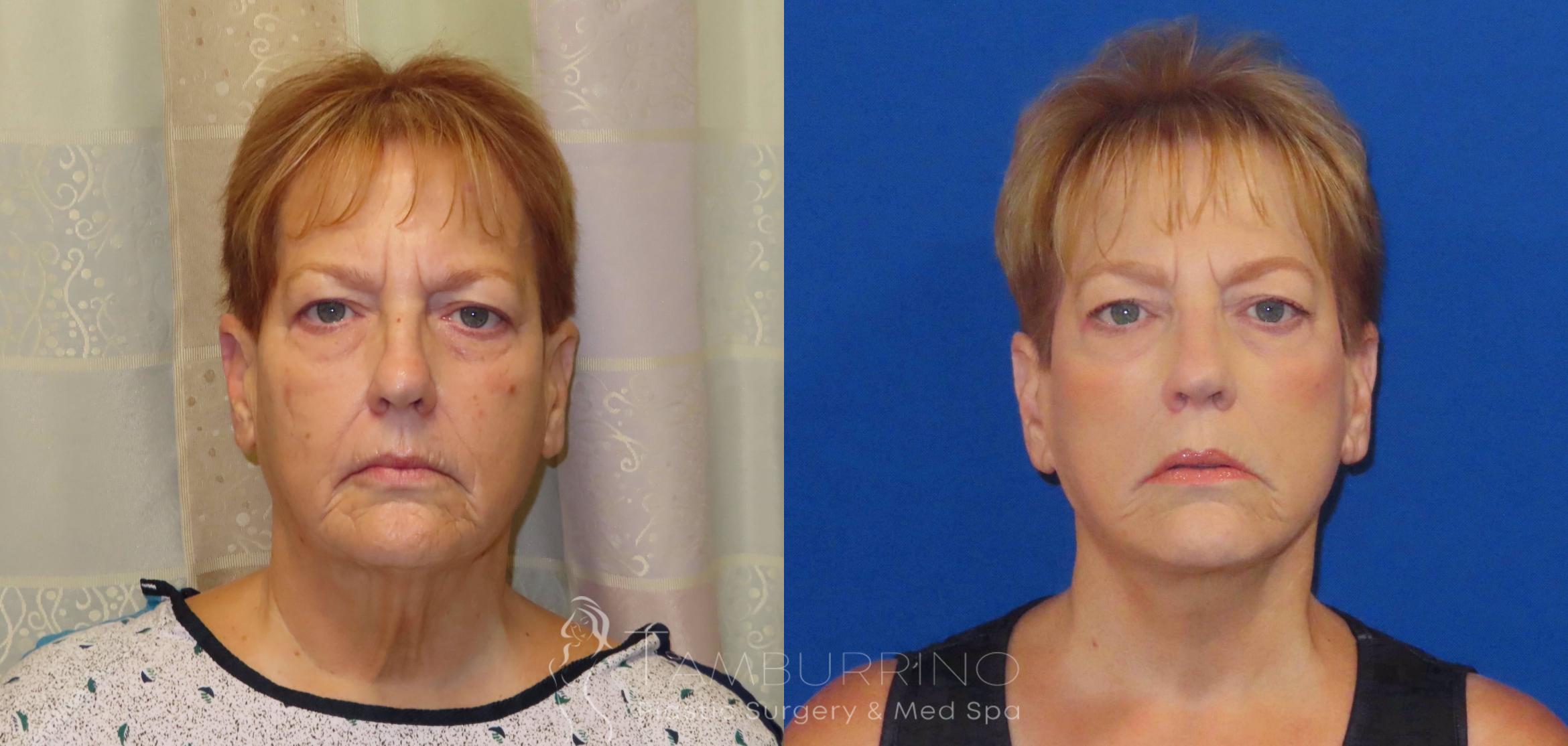 Before & After Facelift Case 65 Frontal View in Doylestown, PA