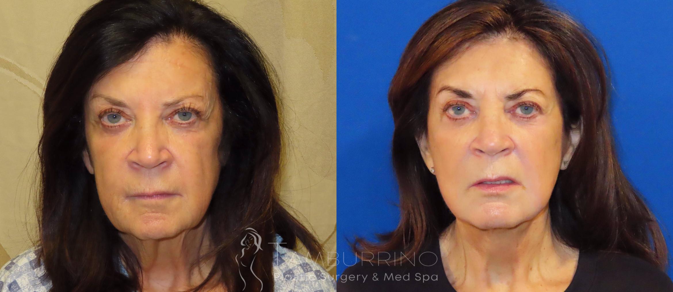 Before & After Facelift Case 66 Frontal View in Doylestown, PA