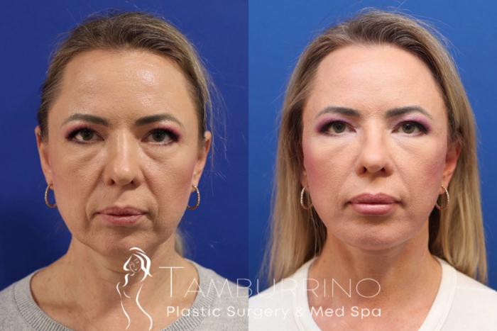 Before & After Neck Lift Case 75