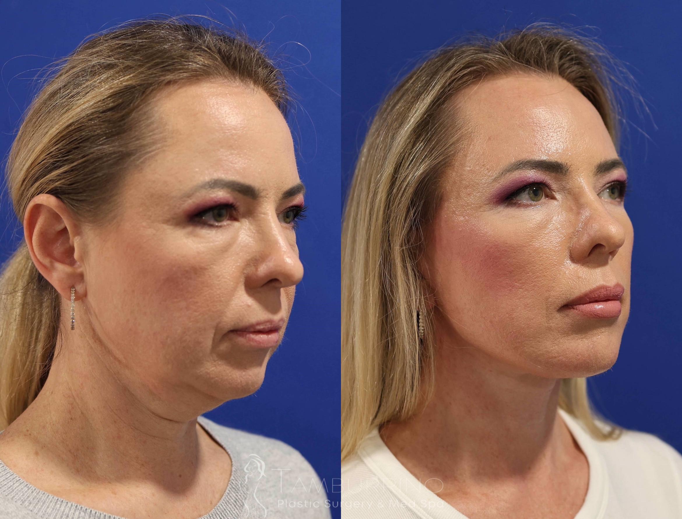 Before & After Facelift Case 75 Right Oblique View in Doylestown, PA