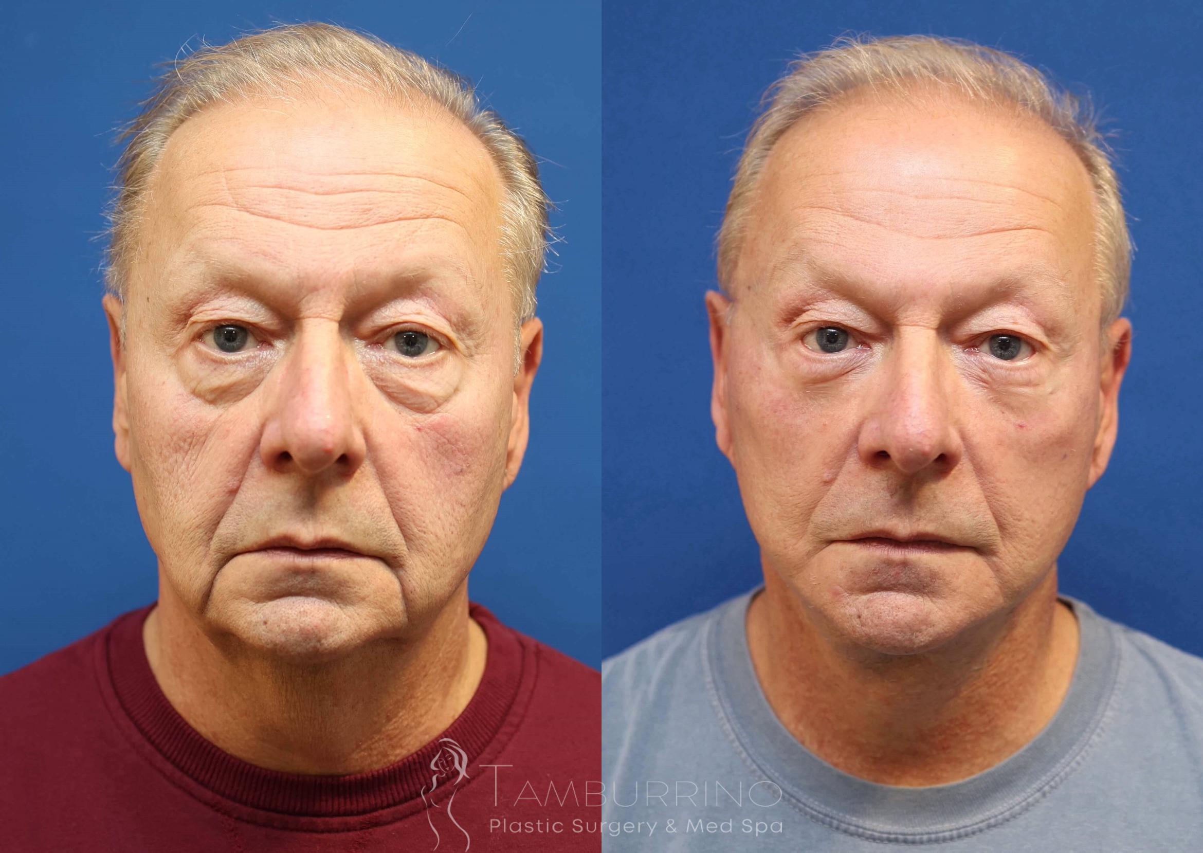 Before & After Facelift Case 76 Frontal View in Doylestown, PA
