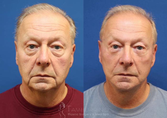 Before & After Neck Lift Case 76
