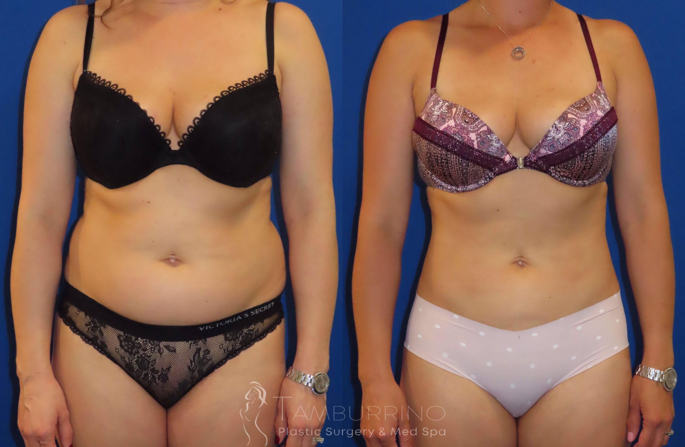 Before & After Liposuction Case 21 Frontal View in Doylestown, PA