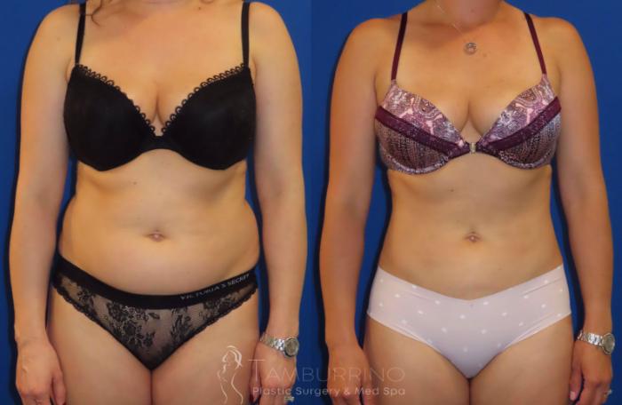 Smartlipo® Before and After