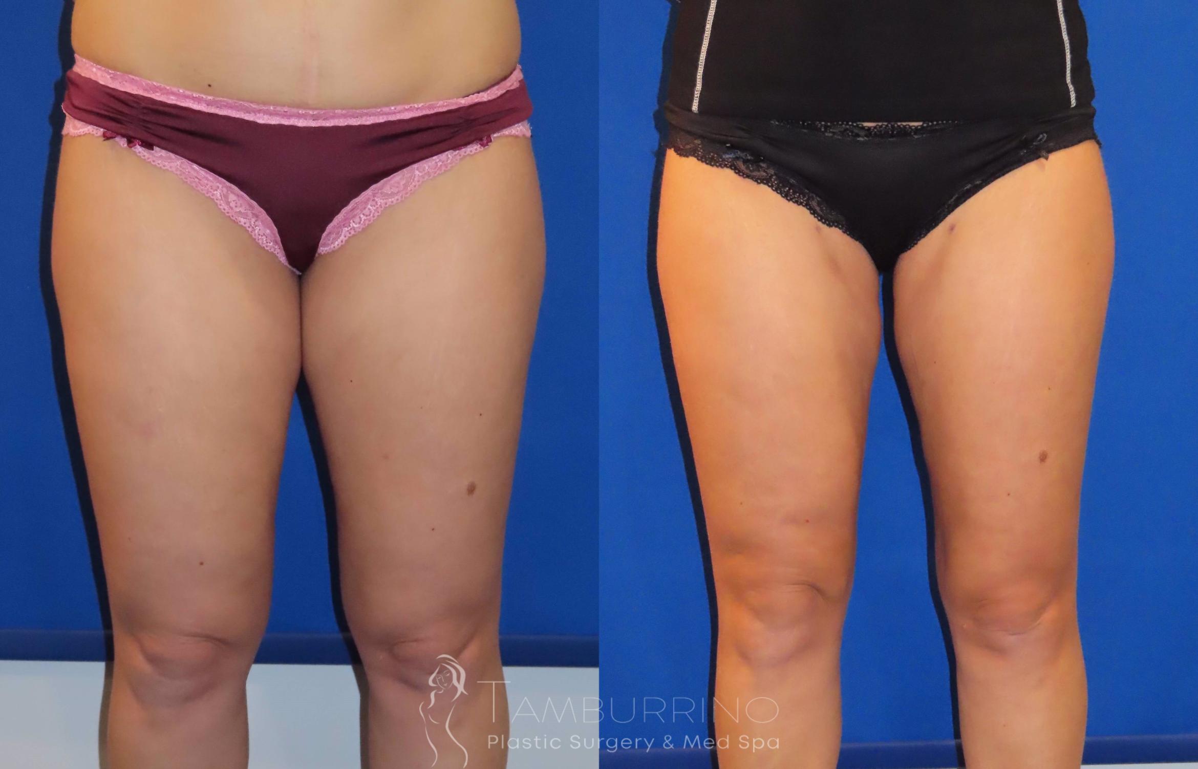 Before & After Liposuction Case 22 Frontal View in Doylestown, PA