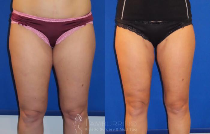 Before & After Smartlipo® Case 22