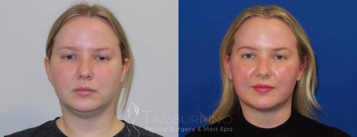 Before & After Smartlipo® Case 23