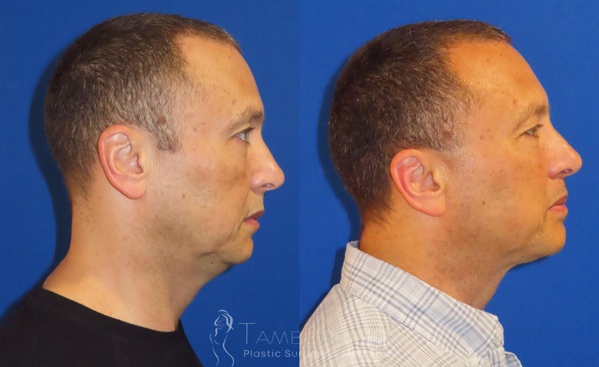 Before & After Liposuction Case 42 Neck Liposuction #1 View in Doylestown, PA