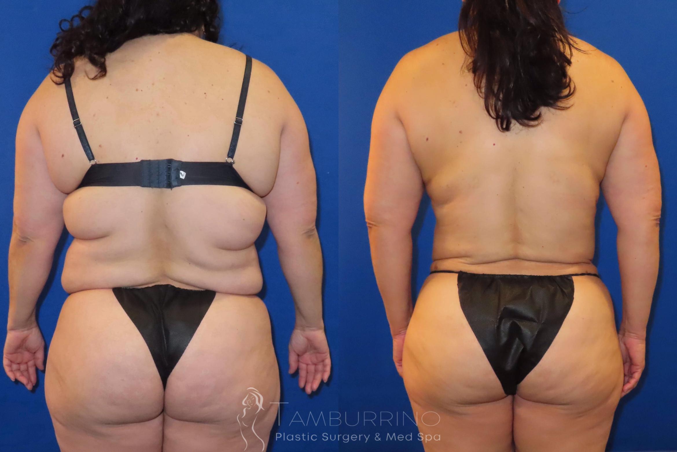 Before & After Liposuction Case 52 Back View in Doylestown, PA