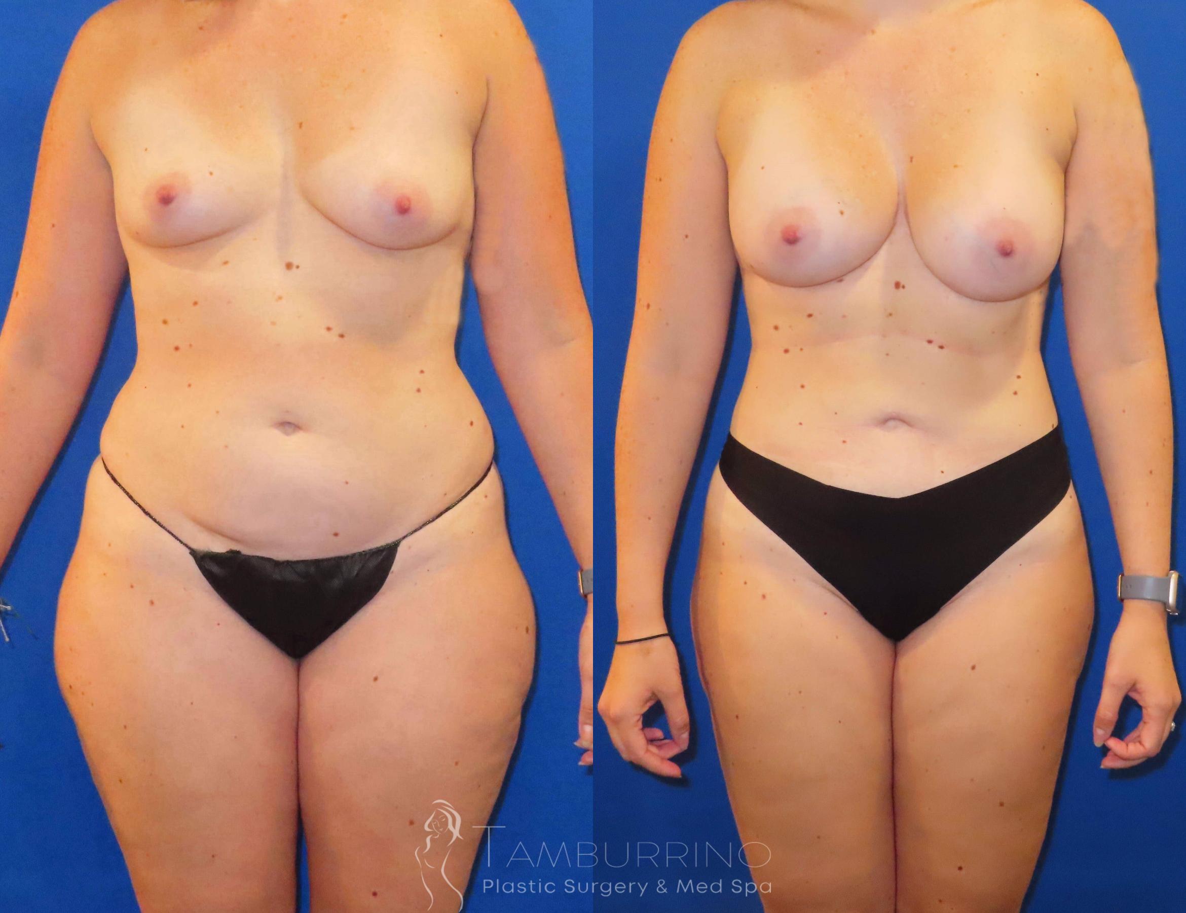Before & After Liposuction Case 56 Frontal View in Doylestown, PA