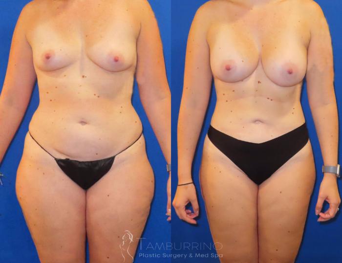 Before & After Liposuction Case 56