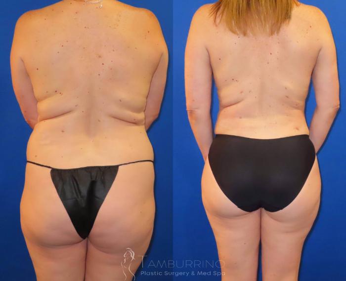 Before & After Liposuction Case 58