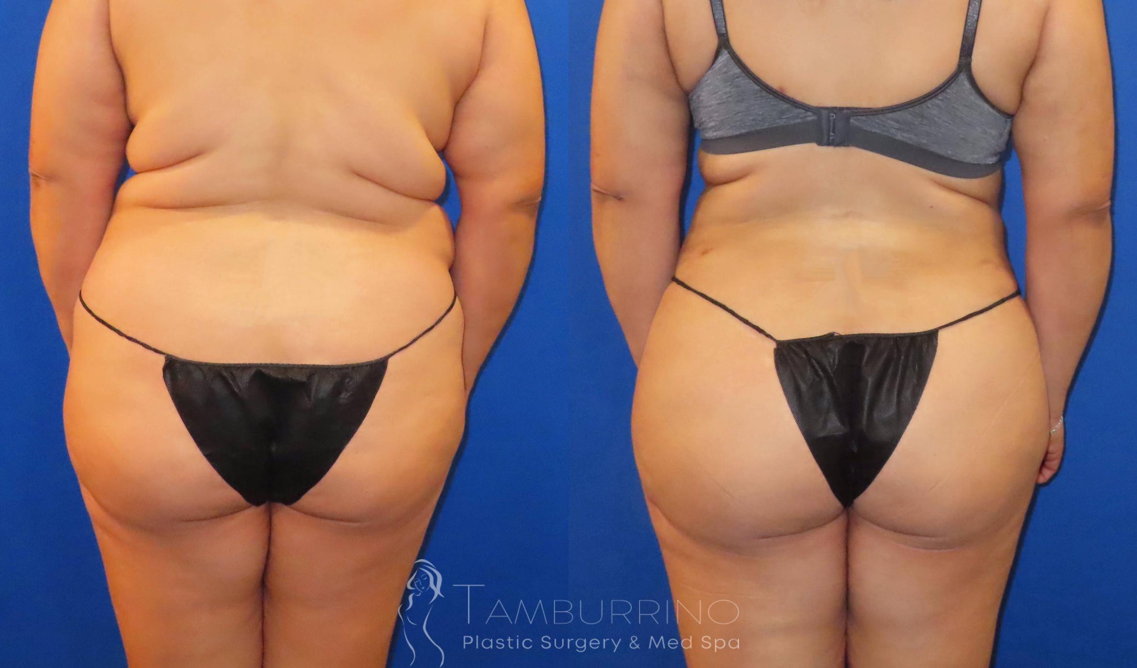 Before & After Liposuction Case 59 Back View in Doylestown, PA