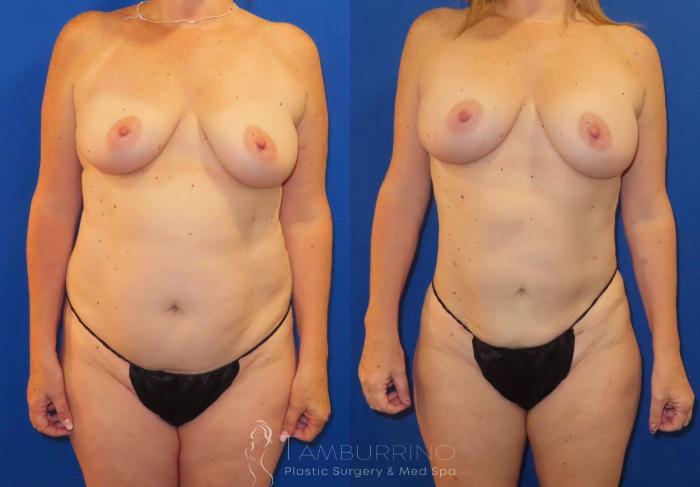 Before & After Liposuction Case 62
