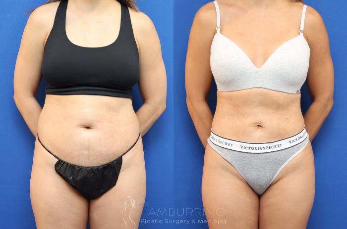 Before & After Liposuction Case 78