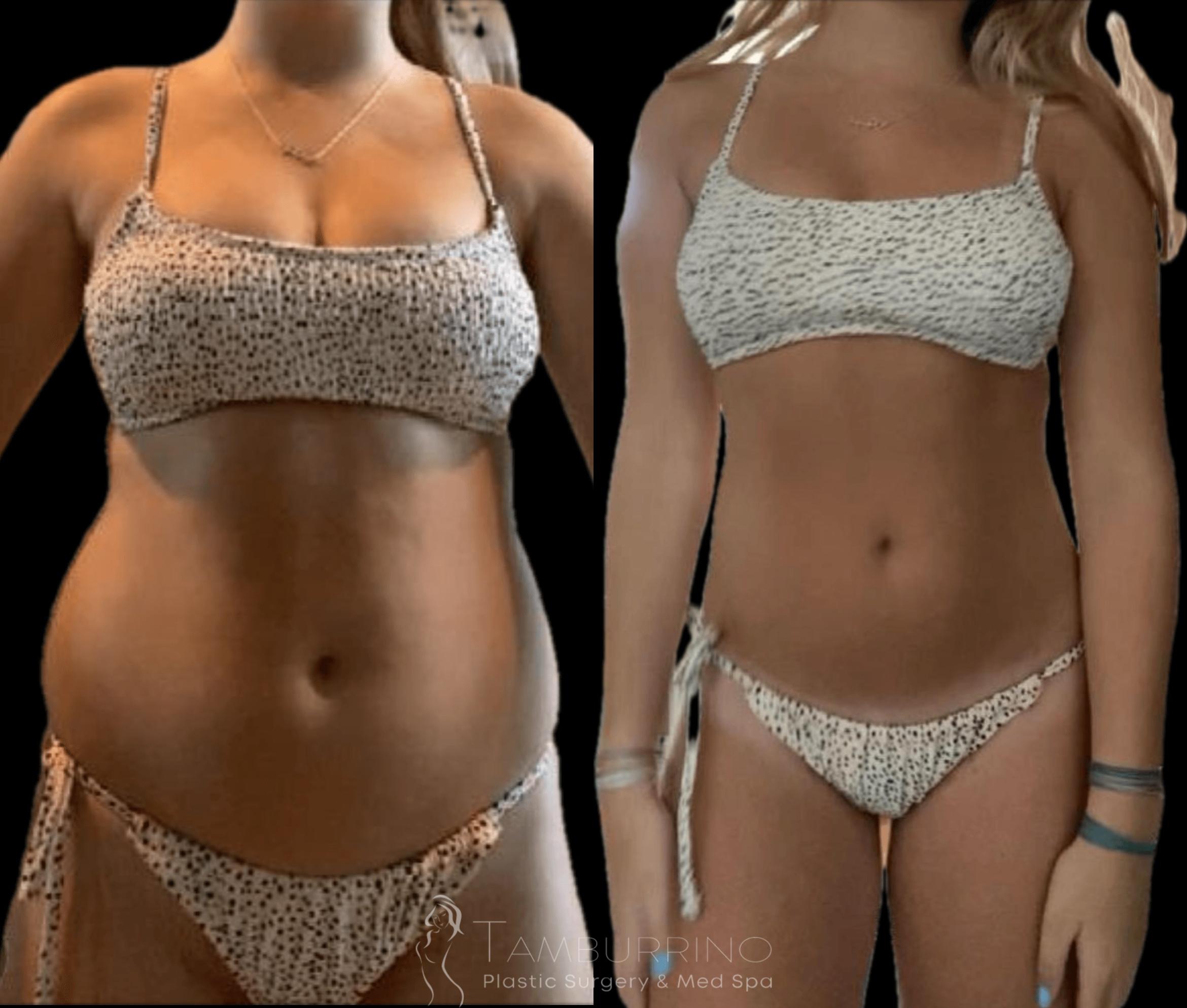 Before & After Liposuction Case 79 Front View in Doylestown, PA