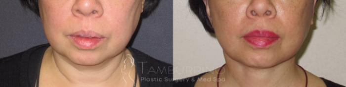 Before & After Neck Lift Case 44