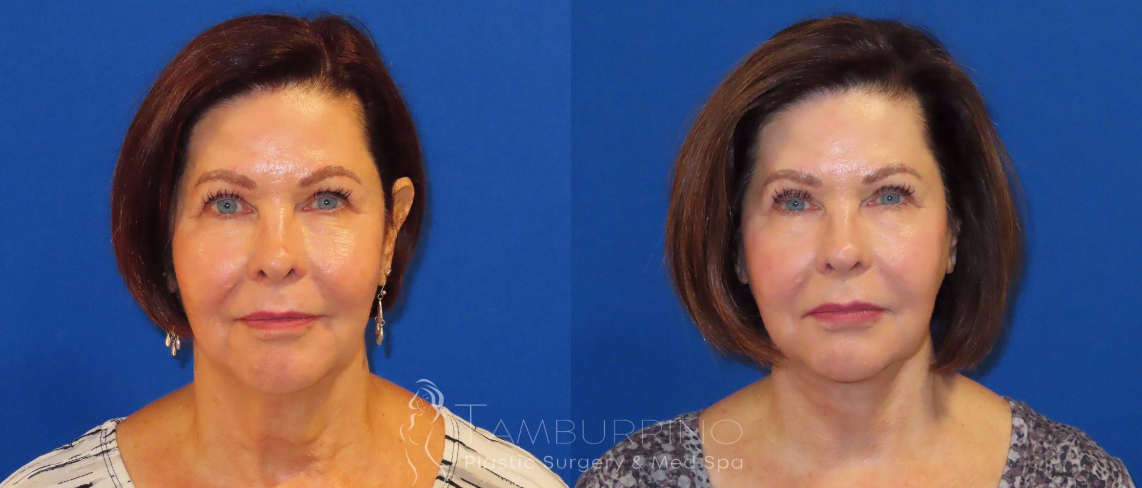 Before & After Neck Lift Case 61 Front View in Doylestown, PA