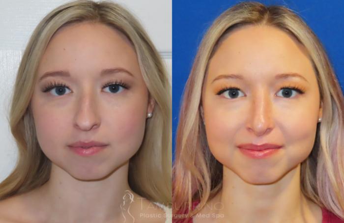 Rhinoplasty