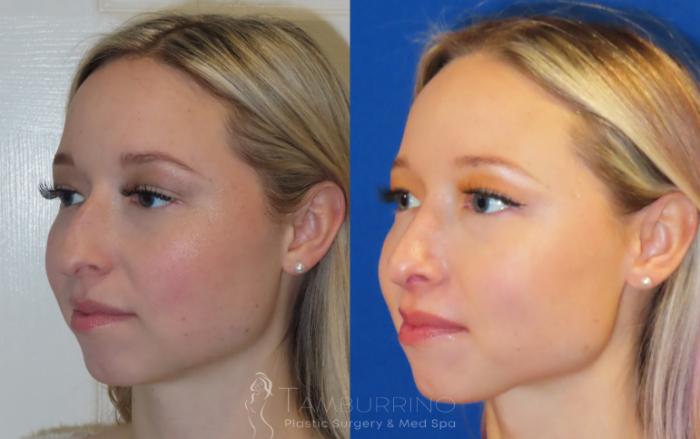 Rhinoplasty