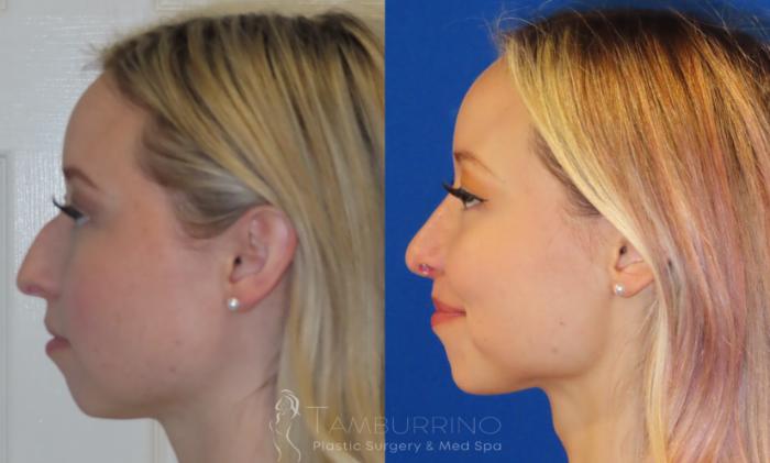 Rhinoplasty