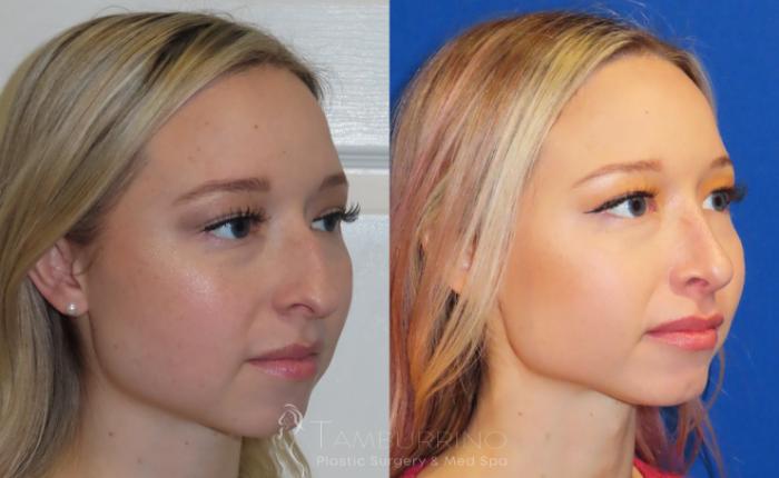 Rhinoplasty