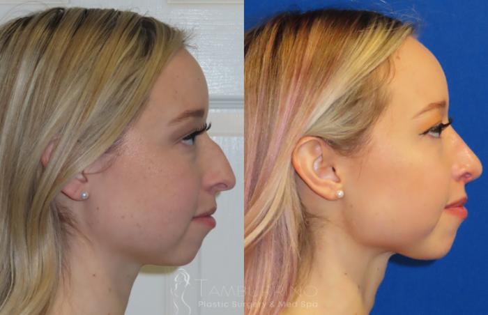 Rhinoplasty Before and After