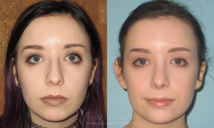 Before & After Rhinoplasty Case 18