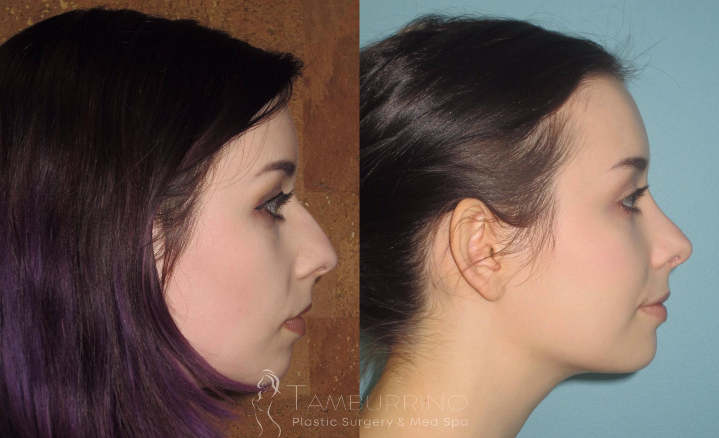 Before & After Rhinoplasty Case 18 Side #1 View in Doylestown, PA