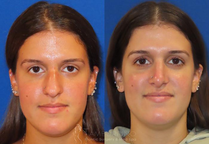Rhinoplasty