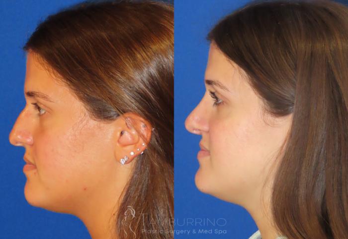 Rhinoplasty