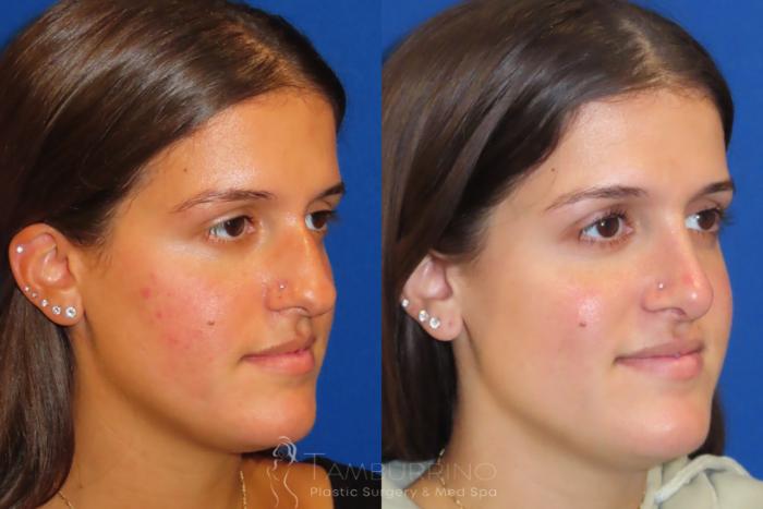 Before & After Rhinoplasty Case 27