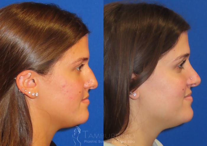 Rhinoplasty