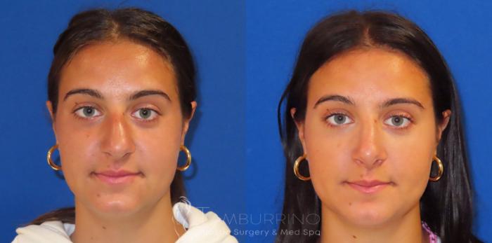 Before & After Rhinoplasty Case 40