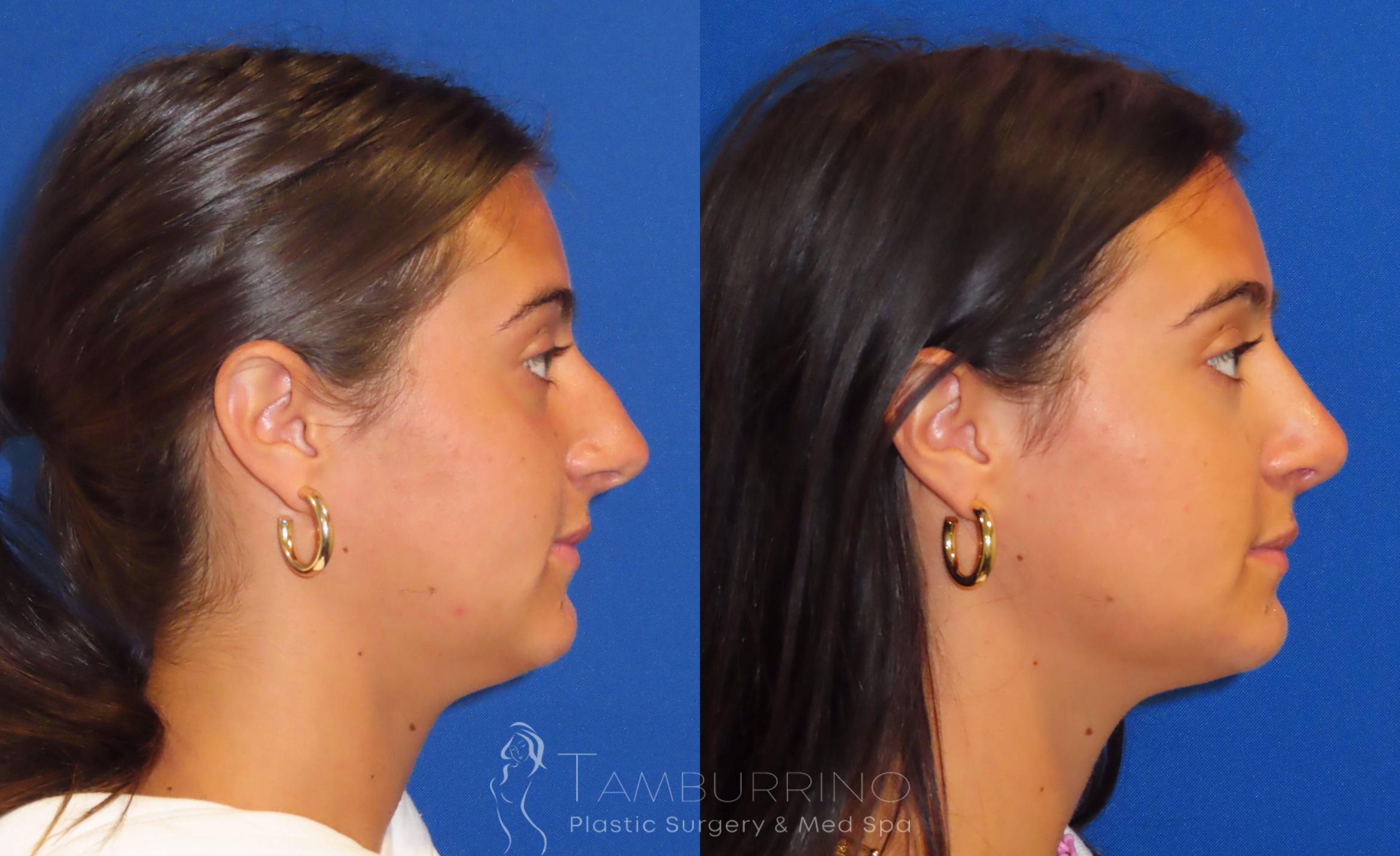 Before & After Rhinoplasty Case 40 Right Lateral View in Doylestown, PA