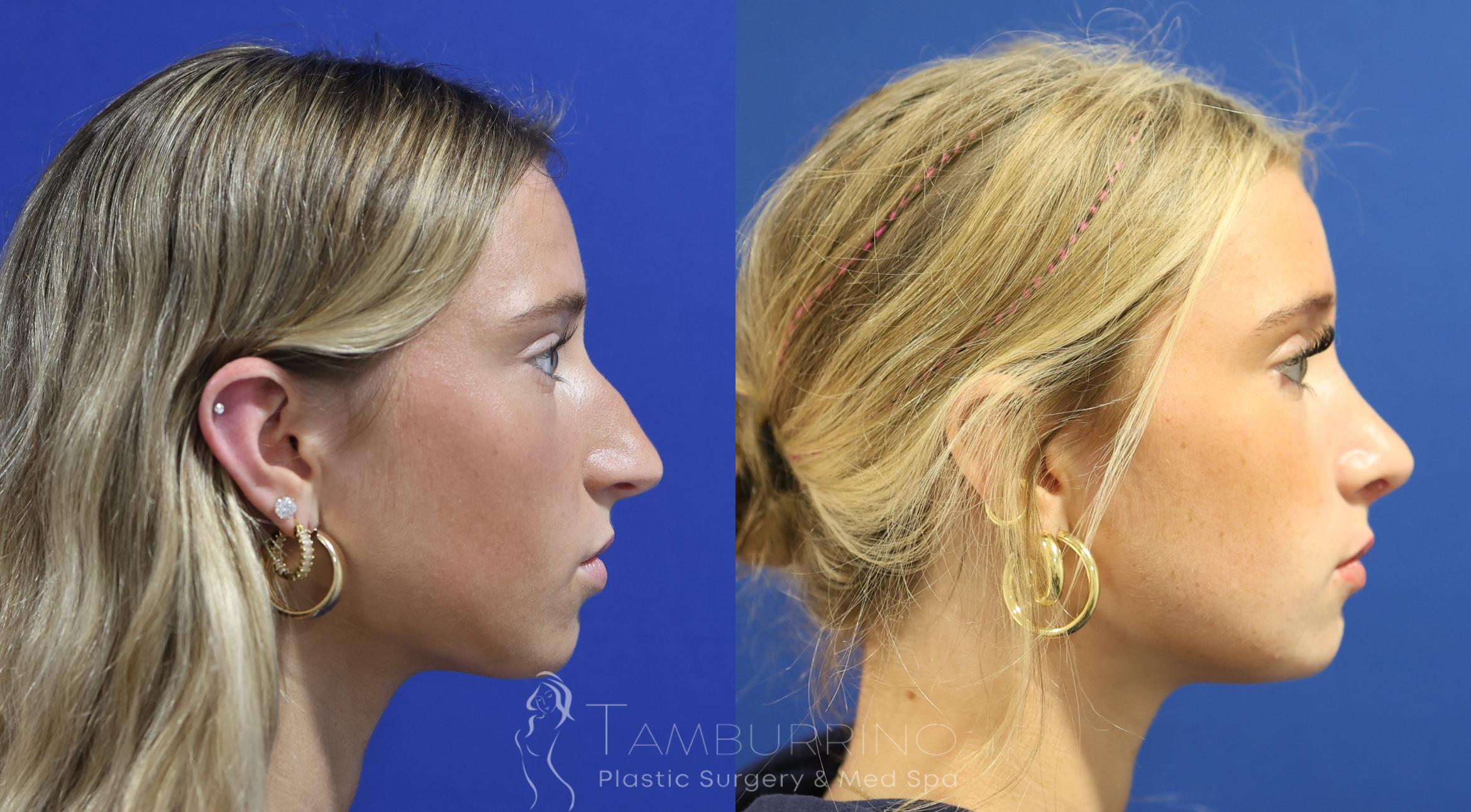 Before & After Rhinoplasty Case 94 Right Side View in Doylestown, PA