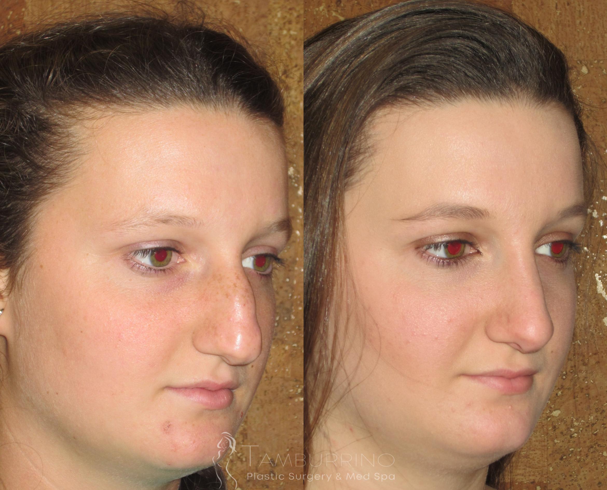 Before & After Rhinoplasty Case 95 Right Oblique View in Doylestown, PA