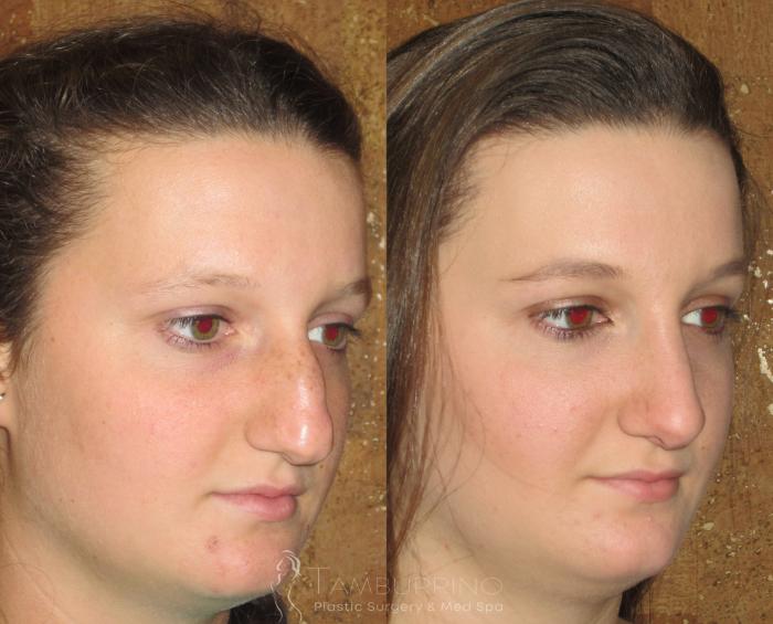Before & After Rhinoplasty Case 95